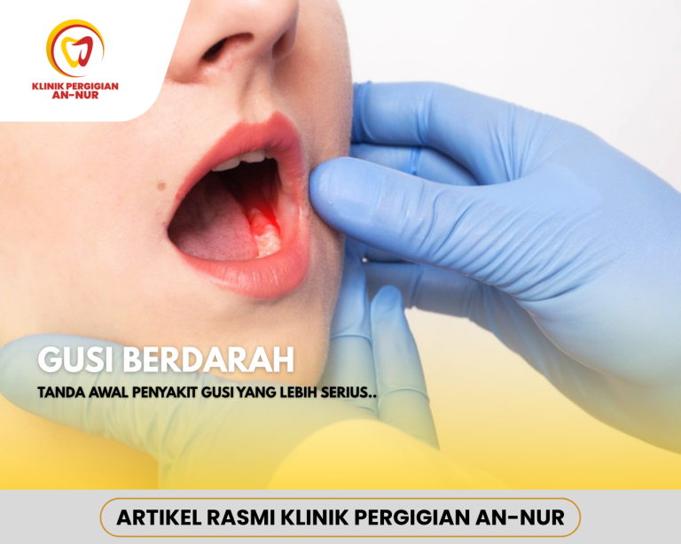 Artikel Klinik Gigi - Gusi Berdarah