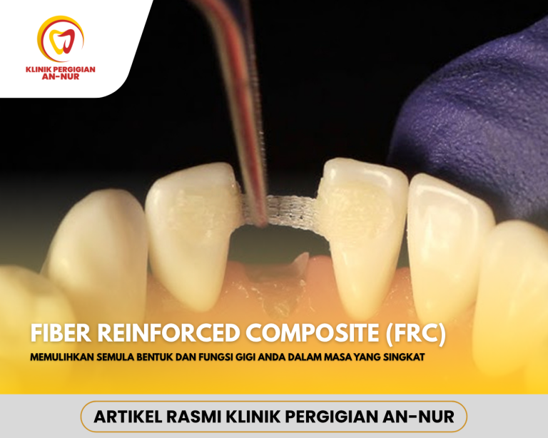 Artikel web dental FRC